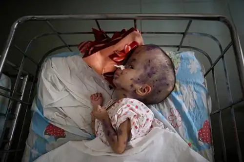 Agent Orange 40 лет спустя: душераздирающие фотографии внутри детских домов во Вьетнаме