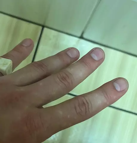 Белые пятна на пальцах