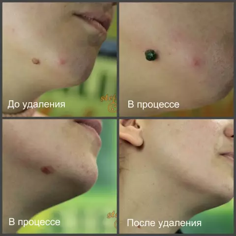 Как удалить родинок с помощью домашних ингредиентов